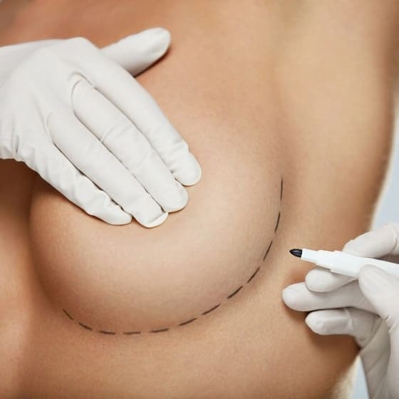 Breast Augmentation in Chicago, IL