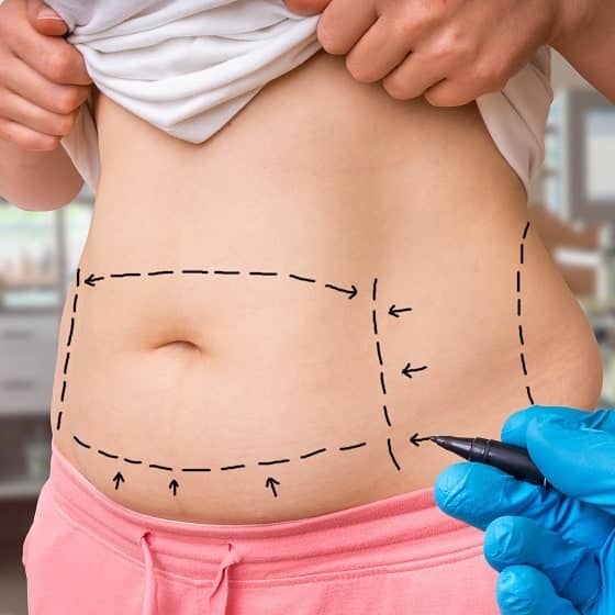 Tummy Tuck Surgery in Chicago, IL