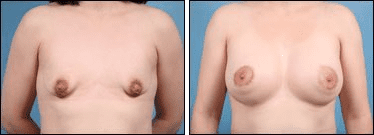 Before and After Image: Breast Augmentation - front