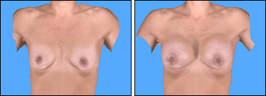 Before and After Image: Breast Augmentation - front