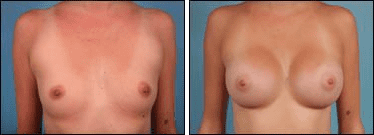 Before and After Image: Breast Augmentation - front