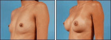 Before and After Image: Breast Augmentation - left-front-oblique