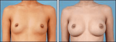 Before and After Image: Breast Augmentation - front
