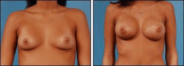 Before and After Image: Breast Augmentation - front