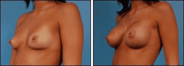 Before and After Image: Breast Augmentation - left-front-oblique
