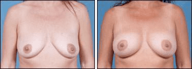 Before and After Image: Breast Augmentation - front