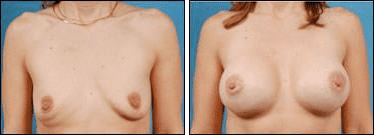 Before and After Image: Breast Augmentation - front