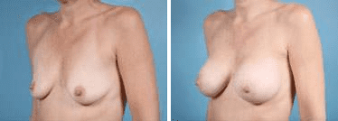 Before and After Image: Breast Augmentation - left-front-oblique