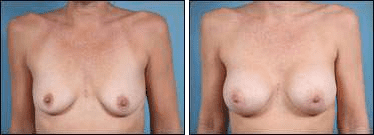 Before and After Image: Breast Augmentation - front