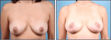 Before and After Image: Breast Lift - front