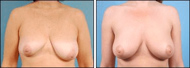 Before and After Image: Breast Lift - front