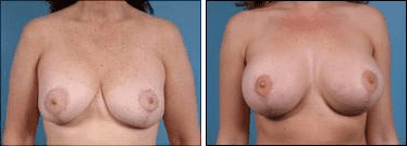 Before and After Image: Breast Lift - front