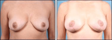 Before and After Image: Breast Lift - front