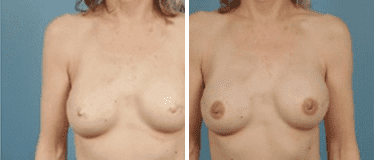 Before and After Image: Nipple Areola Tattooing - front