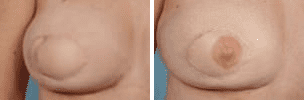 Before and After Image: Nipple Areola Tattooing - front