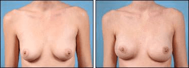 Before and After Image: Breast Reconstruction - front