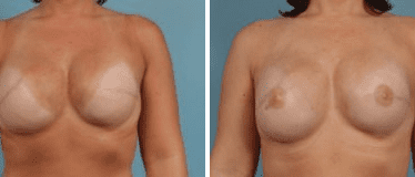 Before and After Image: Nipple Areola Tattooing - front