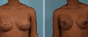 Before and After Image: Nipple Areola Tattooing - front