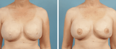 Before and After Image: Nipple Areola Tattooing - front
