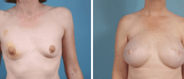 Before and After Image: Nipple Areola Tattooing - front