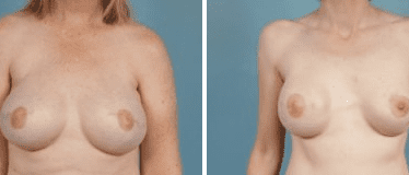 Before and After Image: Nipple Areola Tattooing - front
