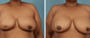 Before and After Image: Nipple Areola Tattooing - front