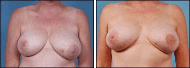 Before and After Image: Breast Reconstruction - front