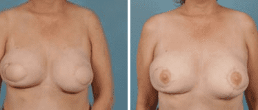 Before and After Image: Nipple Areola Tattooing - front