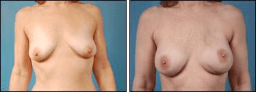 Before and After Image: Breast Reconstruction - front