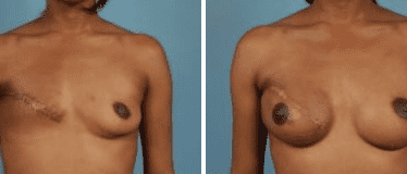Before and After Image: Nipple Areola Tattooing - front