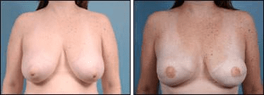 Before and After Image: Breast Reconstruction - front