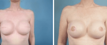 Before and After Image: Nipple Areola Tattooing - front