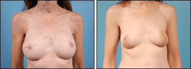 Before and After Image: Breast Reconstruction - front