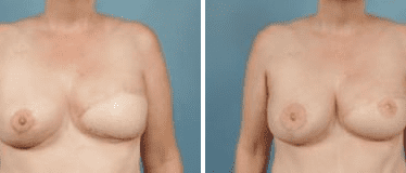 Before and After Image: Nipple Areola Tattooing - front
