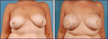 Before and After Image: Breast Reconstruction - front