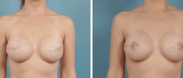Before and After Image: Nipple Areola Tattooing - front