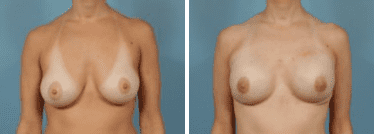 Before and After Image: Breast Reconstruction - front