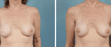 Before and After Image: Nipple Areola Tattooing - front