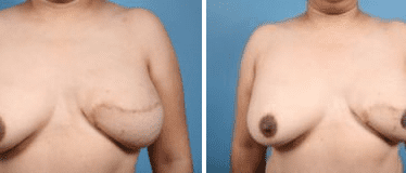 Before and After Image: Nipple Areola Tattooing - front