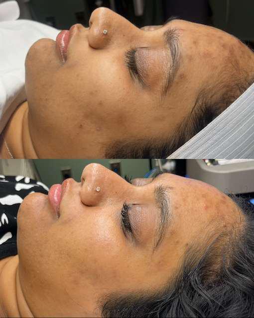 Before and After Image: Acne Scarring/Dark Spots - other
