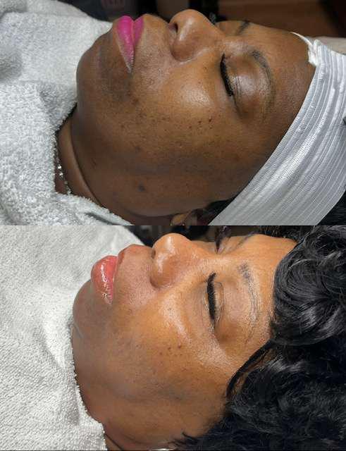 Before and After Image: Acne Scarring/Dark Spots - other