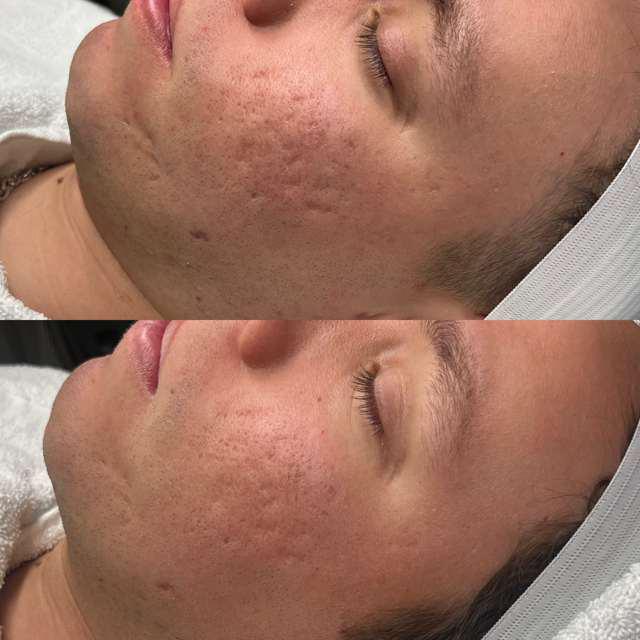 Before and After Image: Acne Scarring - other