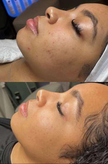 Before and After Image: Acne/Acne Scarring - other