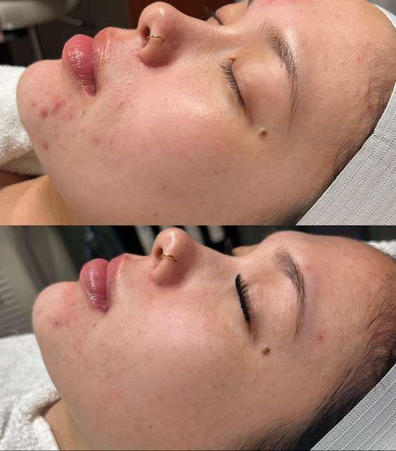 Before and After Image: Acne Scarring P.I.E./ Breakouts - other