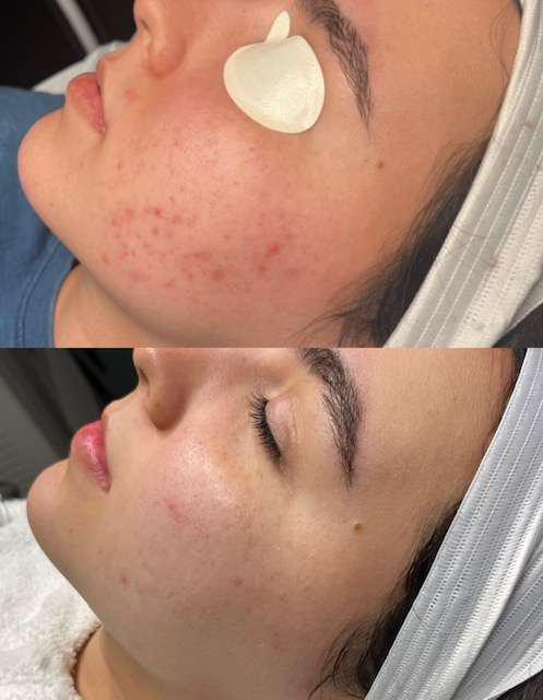 Before and After Image: Acne Scarring P.I.E./ Breakouts - other
