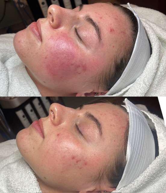 Before and After Image: Acne/Acne Scarring P.I.E. and Redness - other