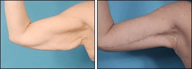 Before and After Image: Arm Lift - front