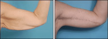 Before and After Image: Arm Lift - front