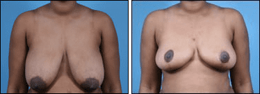 Before and After Image: Breast Reduction - front