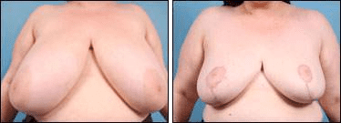 Before and After Image: Breast Reduction - front